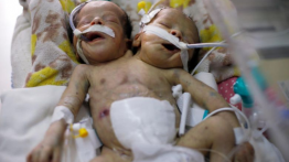 Terlahir di wilayah perang, bayi kembar siam asal Yaman butuh pengobatan di luar negeri