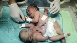 Kondisi bayi kembar siam asal Gaza “kritis”