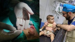 Tim medis AS berhasil mengeluarkan peluru dari kepala seorang bayi Palestina