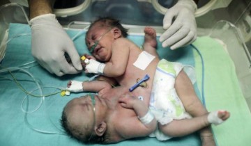 Kondisi bayi kembar siam asal Gaza “kritis”